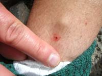 094-Joel_hit_an_agave_and_the_needle_end_broke_in_his_leg-note_the_bump_above_the_puncture
